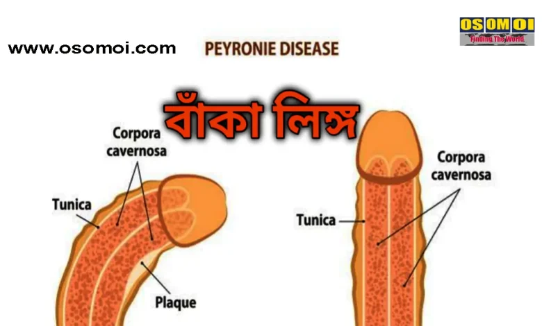 বাঁকা পেনিস সোজা করার উপায়